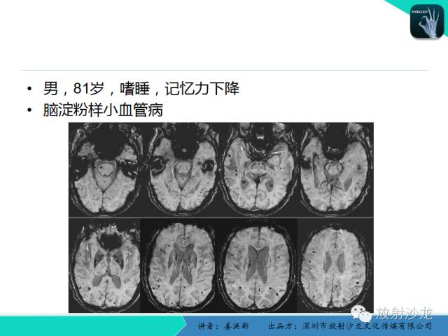 【PPT】脑小血管病MRI影像学研究