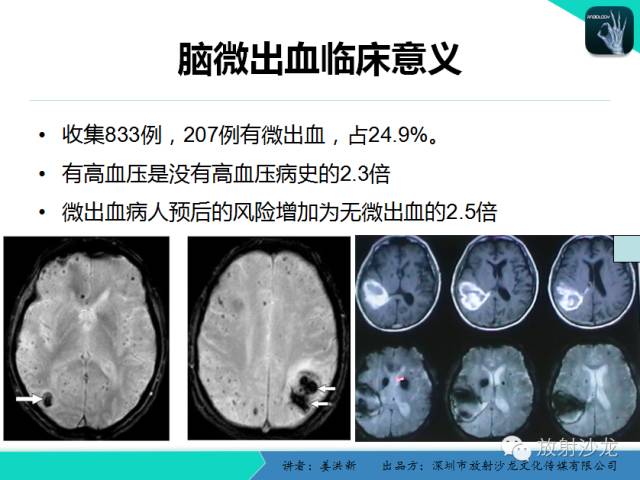 【PPT】脑小血管病MRI影像学研究