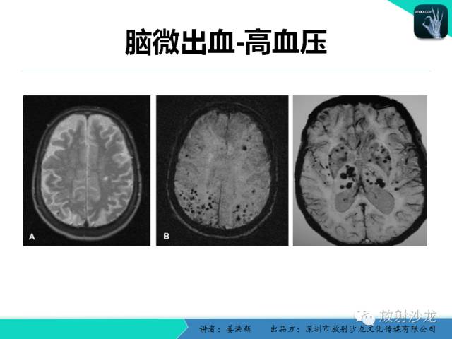 【PPT】脑小血管病MRI影像学研究
