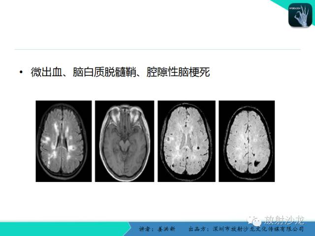 【PPT】脑小血管病MRI影像学研究