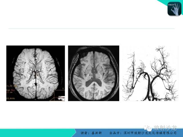 【PPT】脑小血管病MRI影像学研究