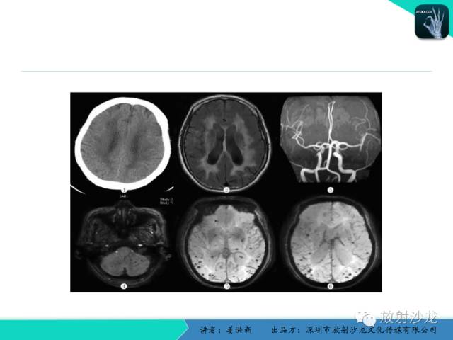 【PPT】脑小血管病MRI影像学研究