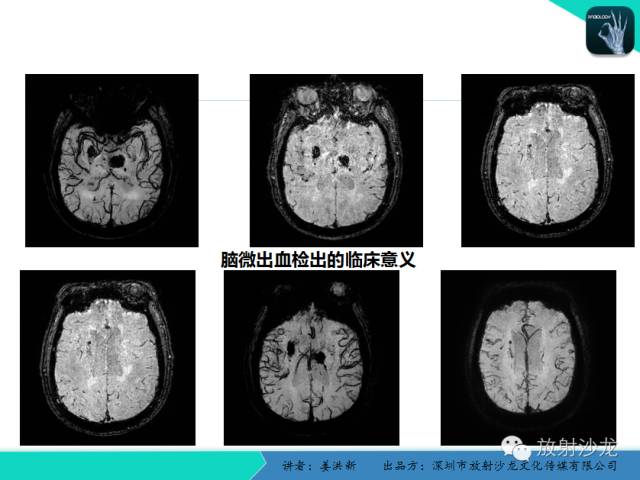 【PPT】脑小血管病MRI影像学研究