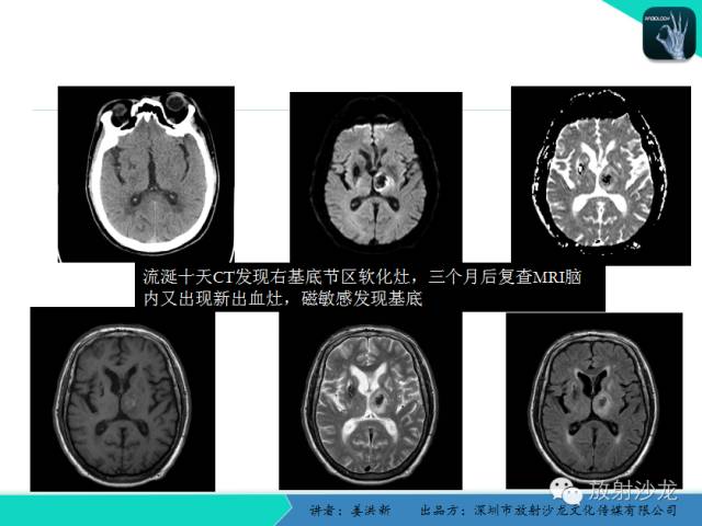 【PPT】脑小血管病MRI影像学研究