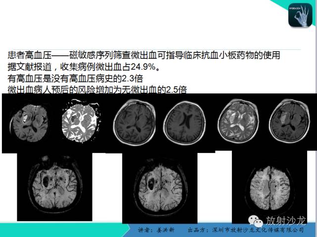 【PPT】脑小血管病MRI影像学研究