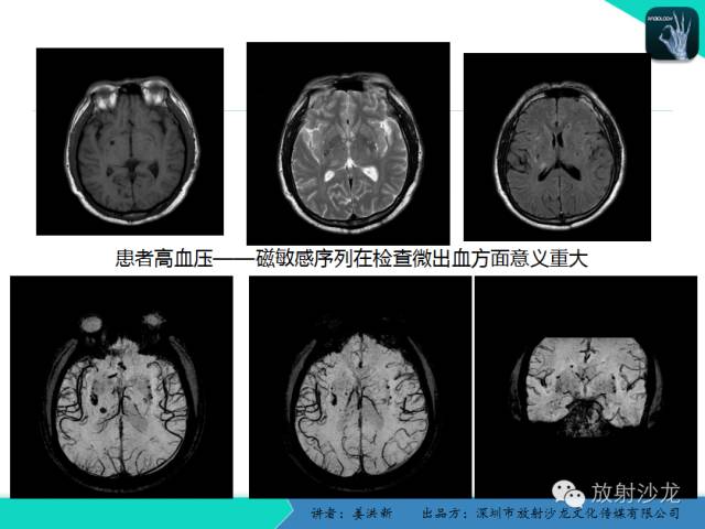 【PPT】脑小血管病MRI影像学研究