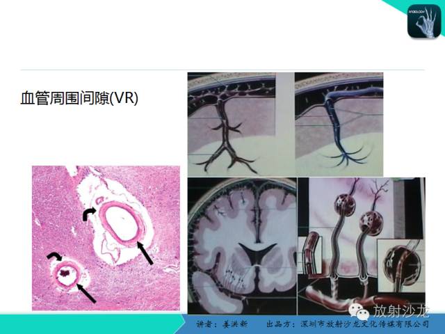 【PPT】脑小血管病MRI影像学研究