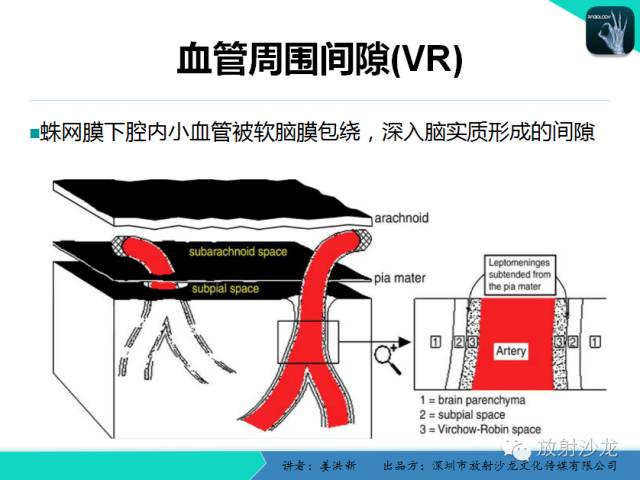 【PPT】脑小血管病MRI影像学研究
