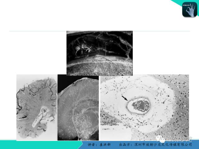 【PPT】脑小血管病MRI影像学研究