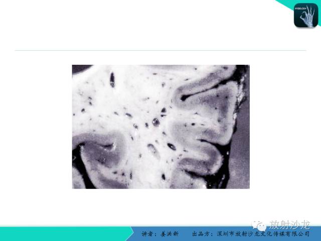 【PPT】脑小血管病MRI影像学研究
