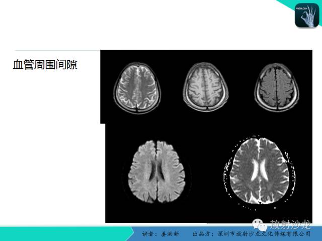 【PPT】脑小血管病MRI影像学研究