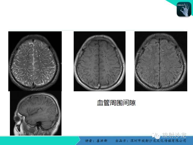 【PPT】脑小血管病MRI影像学研究
