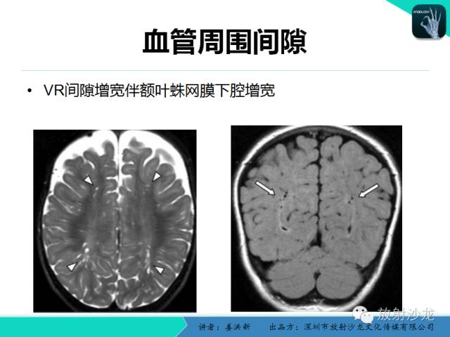 【PPT】脑小血管病MRI影像学研究