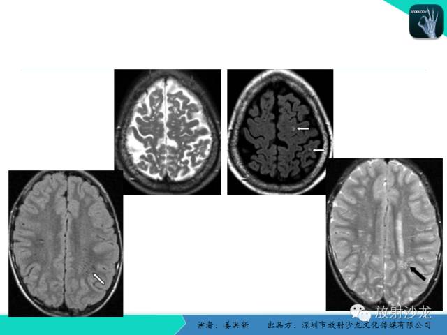 【PPT】脑小血管病MRI影像学研究