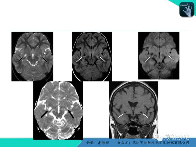 【PPT】脑小血管病MRI影像学研究