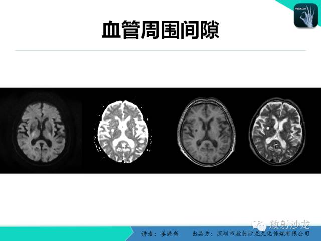 【PPT】脑小血管病MRI影像学研究