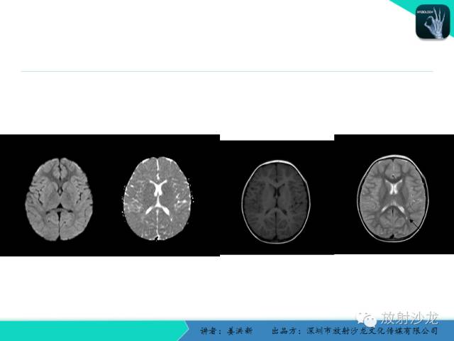 【PPT】脑小血管病MRI影像学研究