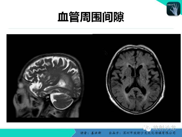 【PPT】脑小血管病MRI影像学研究