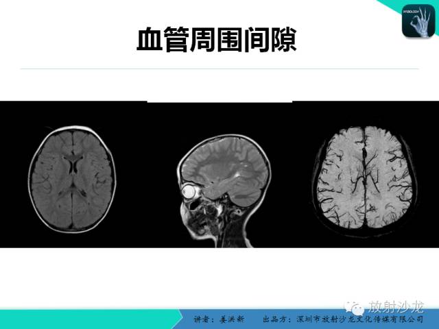 【PPT】脑小血管病MRI影像学研究