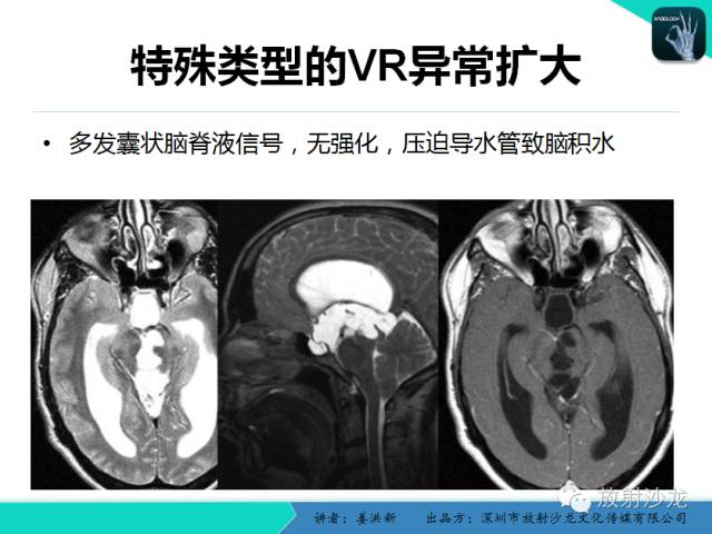 【PPT】脑小血管病MRI影像学研究