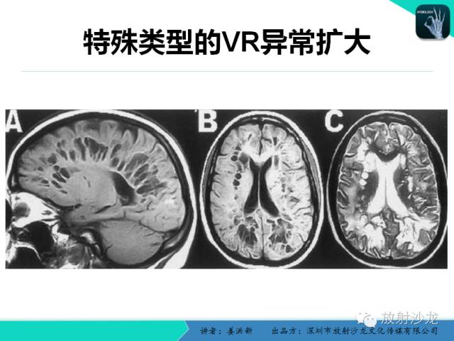 【PPT】脑小血管病MRI影像学研究