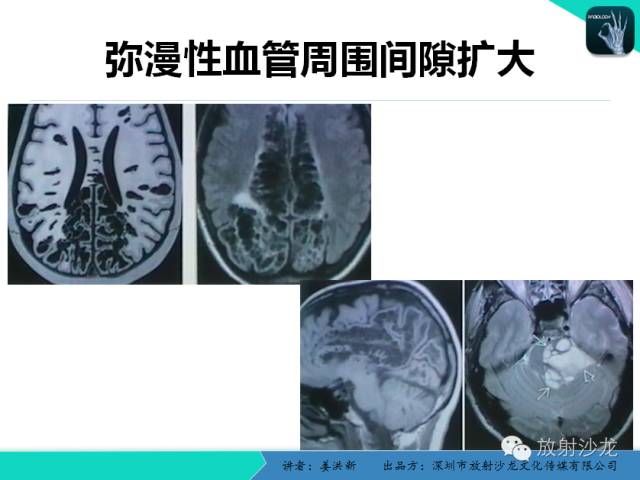 【PPT】脑小血管病MRI影像学研究