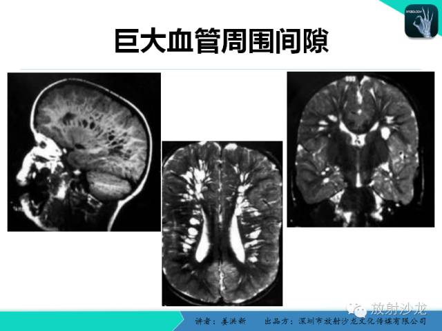 【PPT】脑小血管病MRI影像学研究