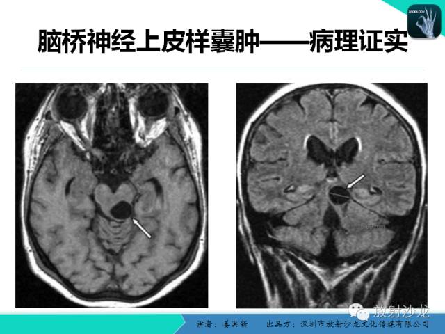 【PPT】脑小血管病MRI影像学研究