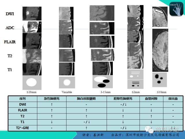 【PPT】脑小血管病MRI影像学研究