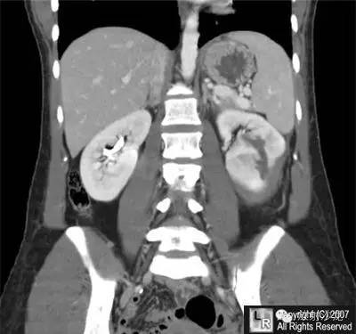 【病例】左肾包膜下血肿及肾裂伤1例CT影像表现