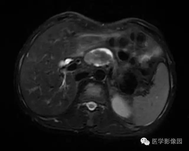 【病例】胰腺内分泌肿瘤1例MR影像表现