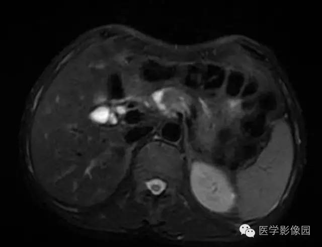 【病例】胰腺内分泌肿瘤1例MR影像表现 【病例】胰腺内分泌肿瘤1例MR影像表现