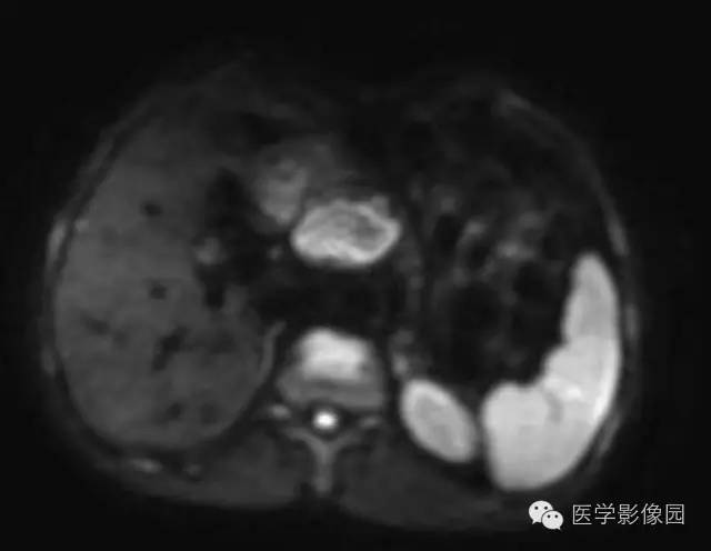 【病例】胰腺内分泌肿瘤1例MR影像表现 【病例】胰腺内分泌肿瘤1例MR影像表现