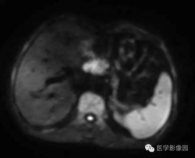 【病例】胰腺内分泌肿瘤1例MR影像表现 【病例】胰腺内分泌肿瘤1例MR影像表现