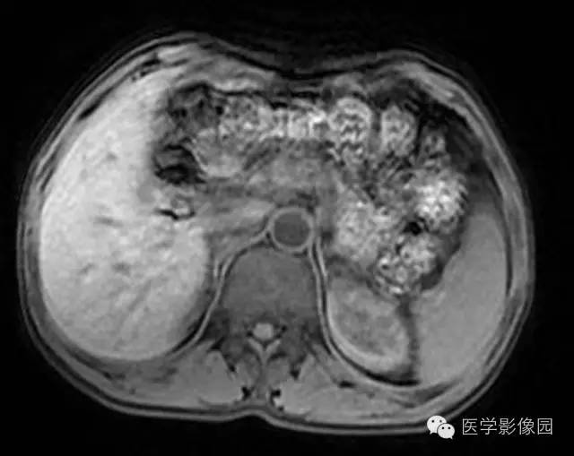 【病例】胰腺内分泌肿瘤1例MR影像表现 【病例】胰腺内分泌肿瘤1例MR影像表现