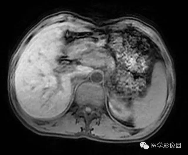【病例】胰腺内分泌肿瘤1例MR影像表现 【病例】胰腺内分泌肿瘤1例MR影像表现
