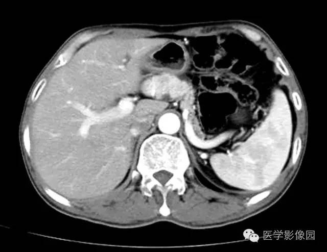 【病例】胰腺内分泌肿瘤1例MR影像表现 【病例】胰腺内分泌肿瘤1例MR影像表现