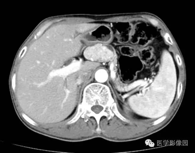 【病例】胰腺内分泌肿瘤1例MR影像表现 【病例】胰腺内分泌肿瘤1例MR影像表现