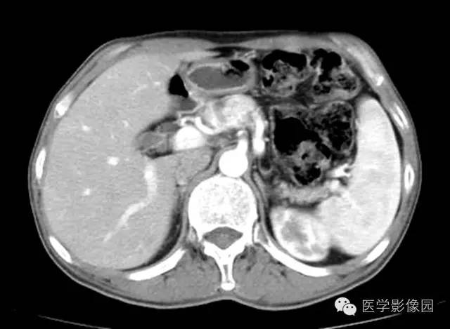 【病例】胰腺内分泌肿瘤1例MR影像表现 【病例】胰腺内分泌肿瘤1例MR影像表现