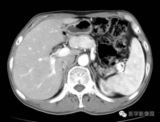 【病例】胰腺内分泌肿瘤1例MR影像表现 【病例】胰腺内分泌肿瘤1例MR影像表现