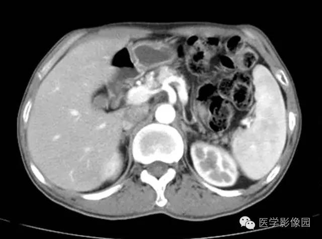 【病例】胰腺内分泌肿瘤1例MR影像表现 【病例】胰腺内分泌肿瘤1例MR影像表现