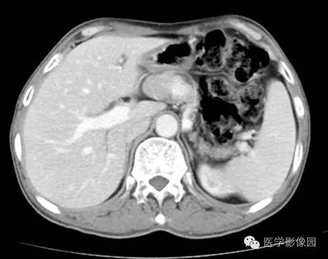 【病例】胰腺内分泌肿瘤1例MR影像表现 【病例】胰腺内分泌肿瘤1例MR影像表现