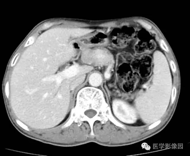 【病例】胰腺内分泌肿瘤1例MR影像表现 【病例】胰腺内分泌肿瘤1例MR影像表现
