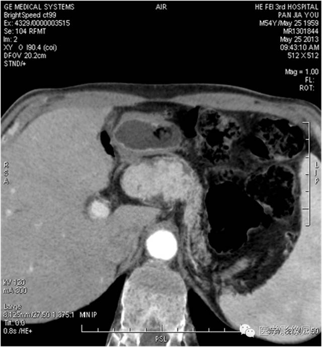 【病例】胰腺内分泌肿瘤1例MR影像表现 【病例】胰腺内分泌肿瘤1例MR影像表现