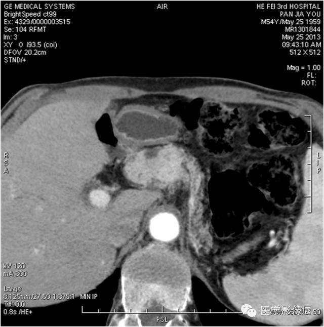 【病例】胰腺内分泌肿瘤1例MR影像表现 【病例】胰腺内分泌肿瘤1例MR影像表现