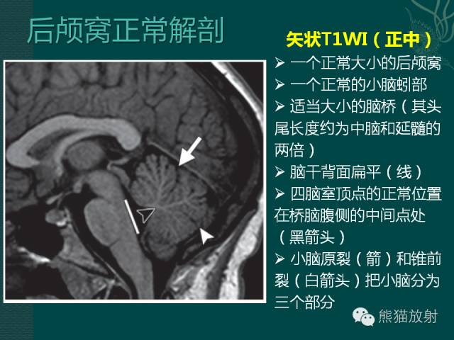 【专题】后颅窝先天性畸形
