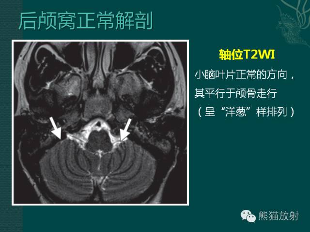 【专题】后颅窝先天性畸形