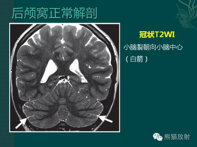 【专题】后颅窝先天性畸形