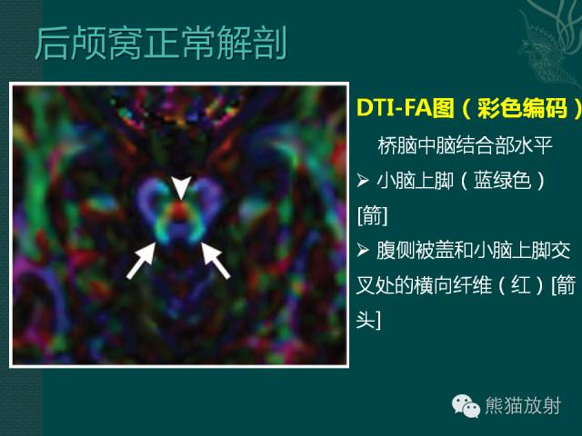 【专题】后颅窝先天性畸形