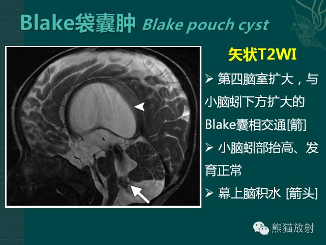 【专题】后颅窝先天性畸形